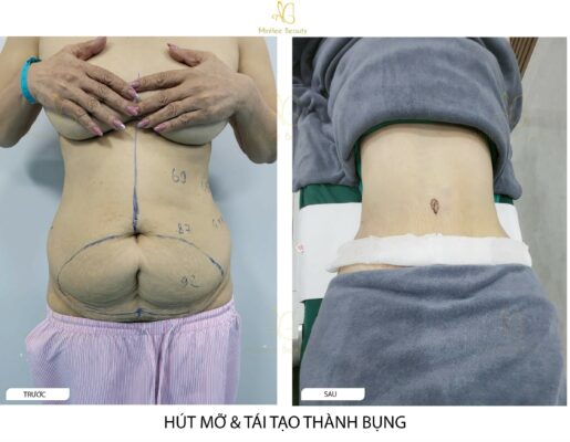 Hút Mỡ Căng Da Bụng – Bí Quyết Để Sở Hữu Vòng Eo Lý Tưởng