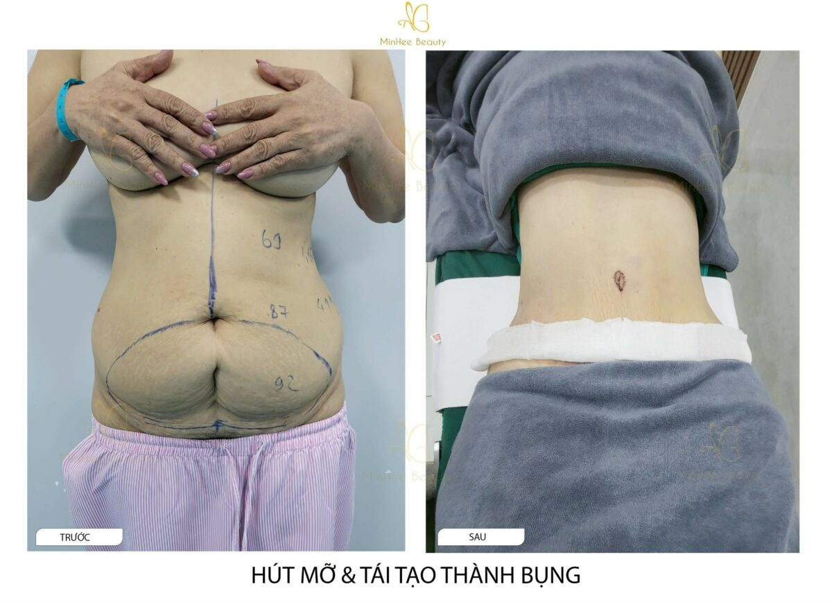Hút Mỡ Căng Da Bụng – Bí Quyết Để Sở Hữu Vòng Eo Lý Tưởng