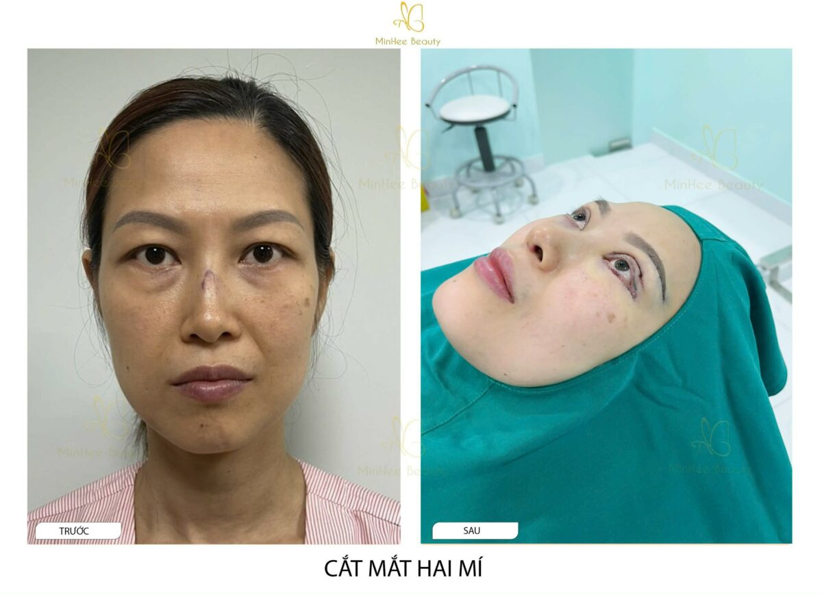 Cắt Mí Dưới Có Để Lại Sẹo Không?
