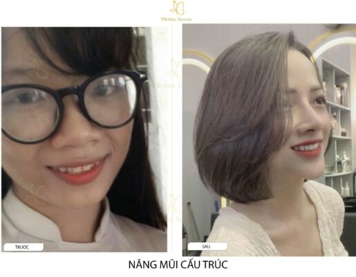 Nâng Mũi Thường Và Nâng Mũi Cấu Trúc Khác Nhau Điểm Gì?
