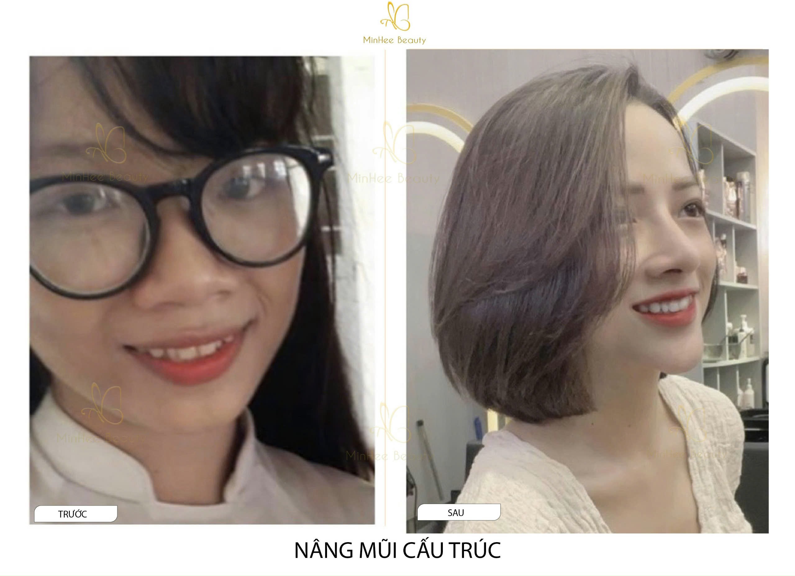 Nâng Mũi Thường Và Nâng Mũi Cấu Trúc Khác Nhau Điểm Gì?